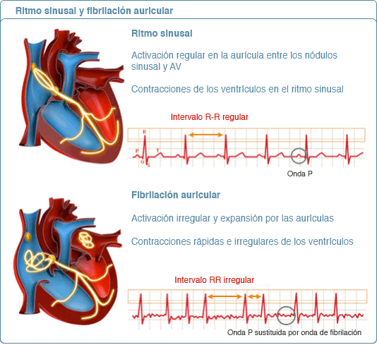 fibrilacao-atrial-atrial-flutter-symptoms-and-causes-mayo-clinic